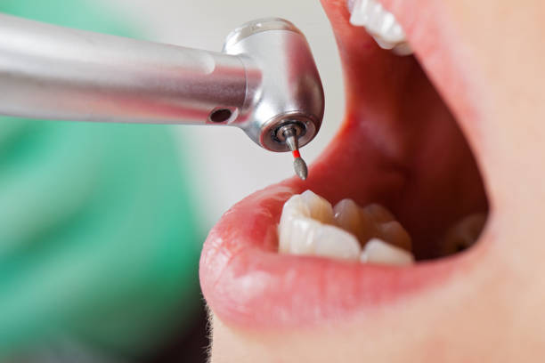 Best Emergency Wisdom Teeth Removal in Fridley, MN